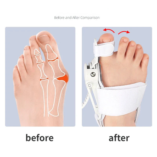 Corector Bunion Confortabil
